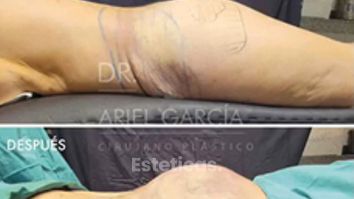 Lipotransferencia Glutea - Dr. Ariel Ignacio Garcia