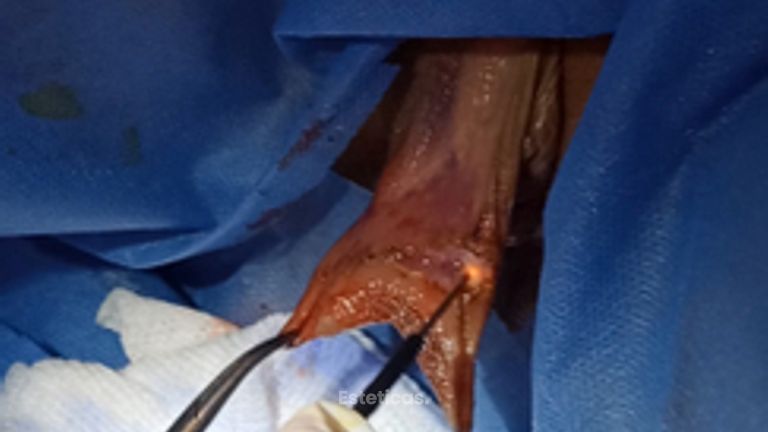 Labioplastia con radiofrecuencia - Dra. Adriana Ratto
