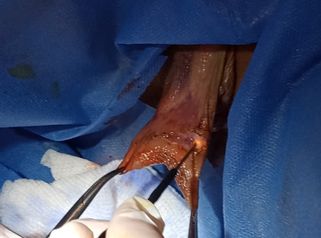 Labioplastia con radiofrecuencia - Dra. Adriana Ratto
