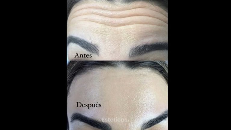 Botox - Dra. Anahi Versace