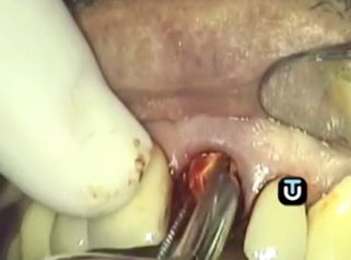 Mejora tu sonrisa con los implantes