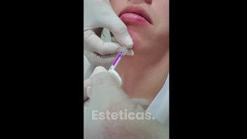 Mentoplastia - Dra. Cristina G. Lazarte