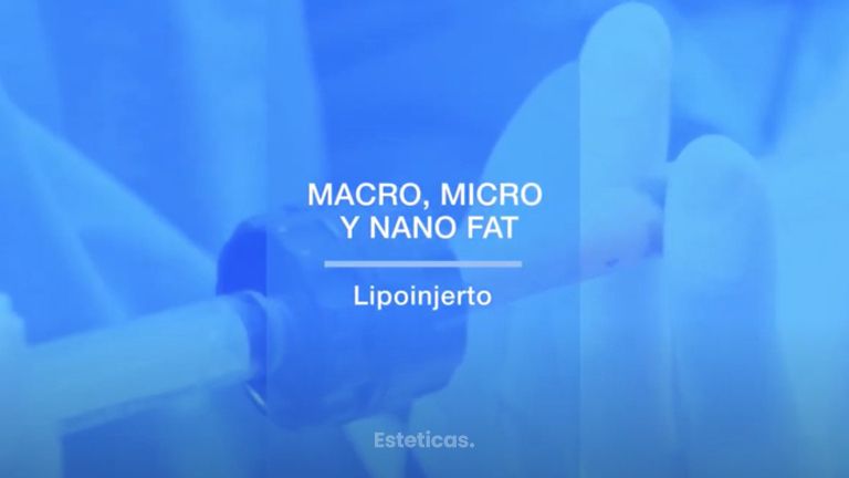 Macro, Micro y Nanofat. Lipofilling  - Dr. Mateo Castro Béduchaud