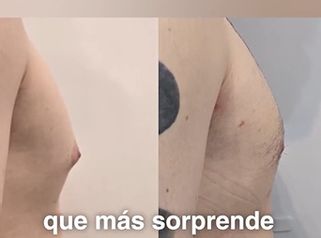 Ginecomastia un diagnóstico correcto puede ser el primer paso. - Dra. Natalia Solimano