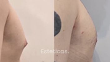 Ginecomastia un diagnóstico correcto puede ser el primer paso. - Dra. Natalia Solimano