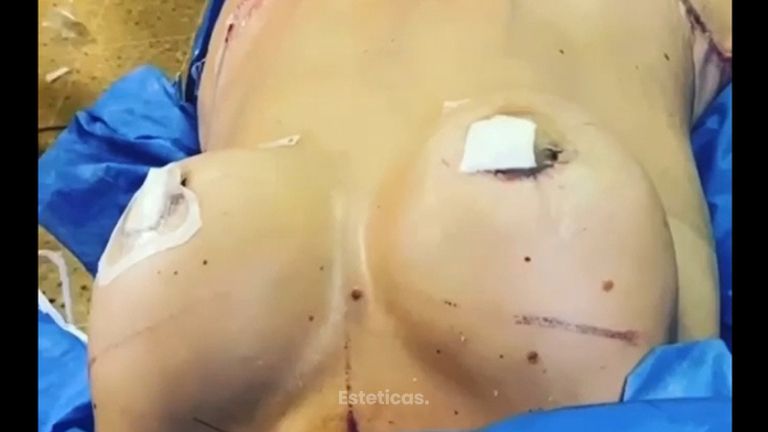 Aumento de mamas - Dr. Fabian Vargas Carrasco