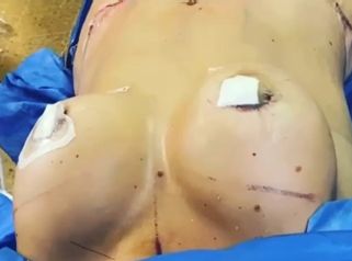 Aumento de mamas - Dr. Fabian Vargas Carrasco