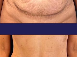 Abdominoplastia - Dr. Agustín Matia