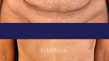 Abdominoplastia - Dr. Agustín Matia