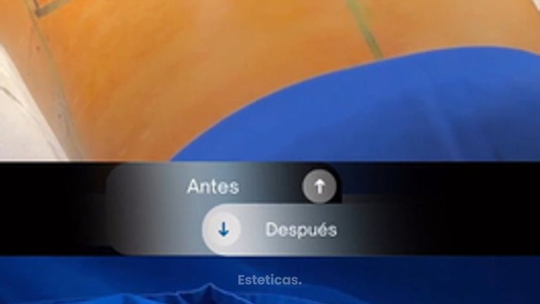 Aumento Mamario con leve asimetria - Dr. Rodolfo Villavicencio