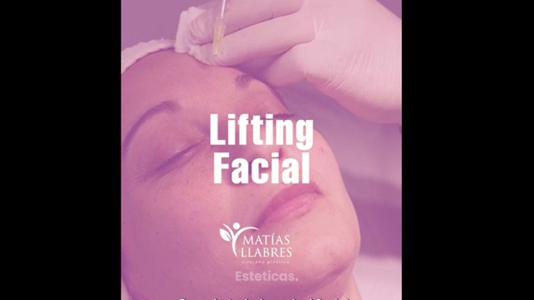Lifting facial - Dr. Matías Llabres