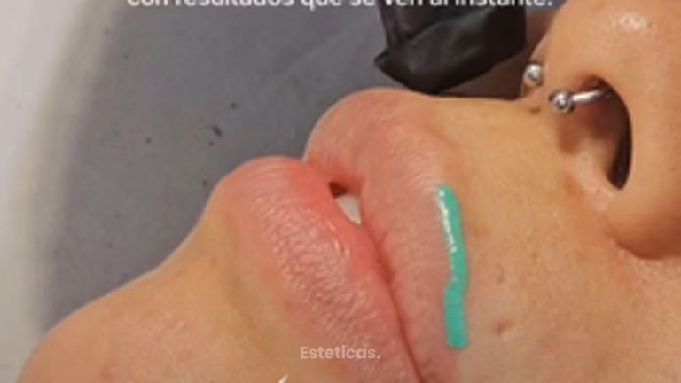 Relleno de Labios - Dr. Maximiliano Gil Miranda
