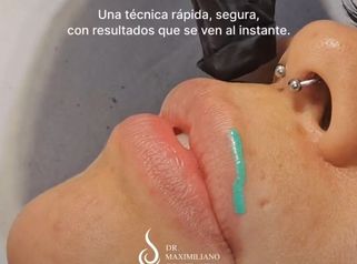 Relleno de Labios - Dr. Maximiliano Gil Miranda