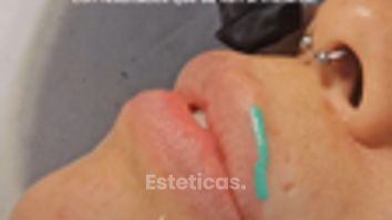 Relleno de Labios - Dr. Maximiliano Gil Miranda