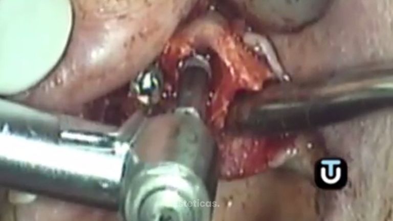 Los implantes mejorarán tu dentadura