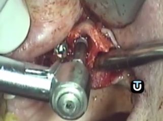 Los implantes mejorarán tu dentadura