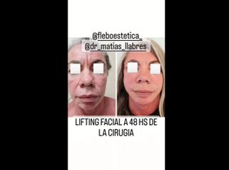 Lifting - Dr. Matías Llabres