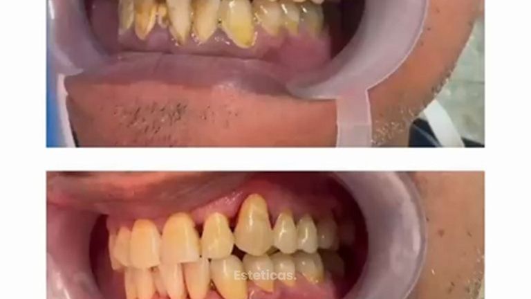 Periodoncia Láser - Dra. Karina Biondi