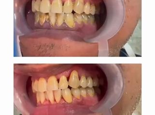 Periodoncia Láser - Dra. Karina Biondi
