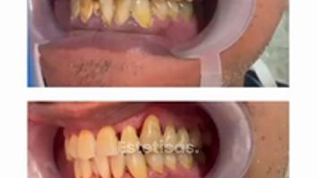 Periodoncia Láser - Dra. Karina Biondi