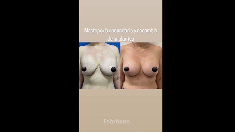 Mastopexia - Dr. Carlos Arce