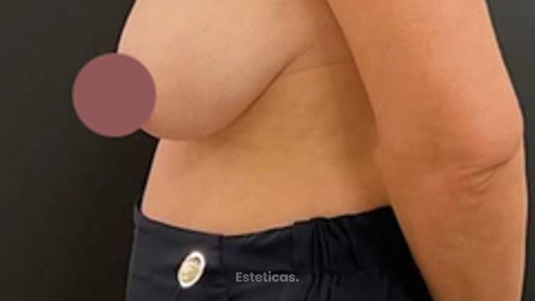 Reducción mamas - Dr. Emmanuel Manavela Chiapero