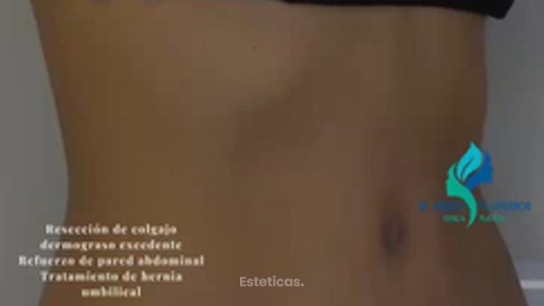 Abdominplastia - Dr. Rodolfo Villaviencio