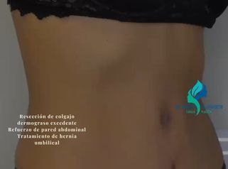 Abdominplastia - Dr. Rodolfo Villaviencio