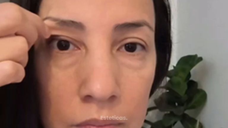 Blefaroplastia - Dra. Mariana Bouvier