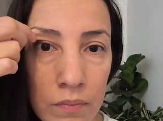 Blefaroplastia - Dra. Mariana Bouvier