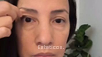 Blefaroplastia - Dra. Mariana Bouvier