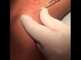 Varices - Clínica Lopez Vargas