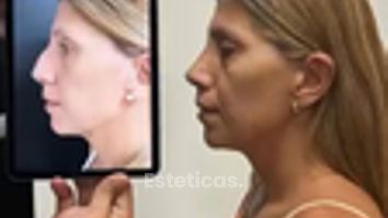 Rinoplastia - Dr. Pablo Santucci