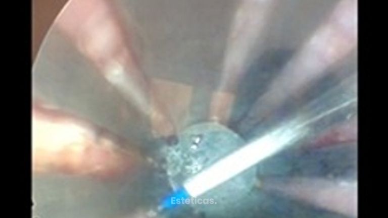 Laser Gyno para incontinencia de Orina y Sequedad vaginal en consultorio sin dolor y sin anestesia