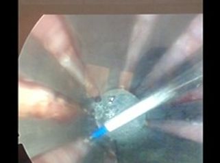 Laser Gyno para incontinencia de Orina y Sequedad vaginal en consultorio sin dolor y sin anestesia