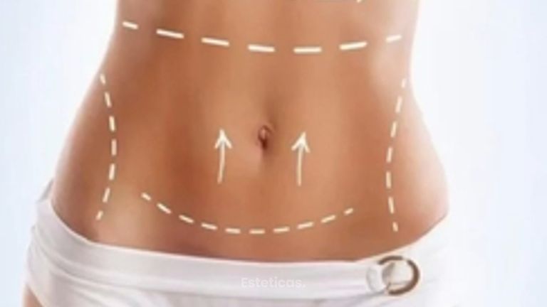 Todo lo que tenes que saber Abdominoplastia - Dr. Rodolfo Villavicencio