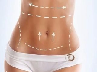 Todo lo que tenes que saber Abdominoplastia - Dr. Rodolfo Villavicencio
