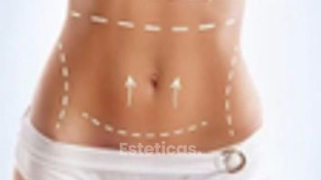 Todo lo que tenes que saber Abdominoplastia - Dr. Rodolfo Villavicencio