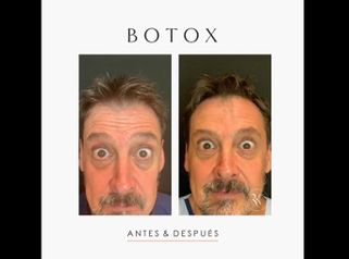 Botox