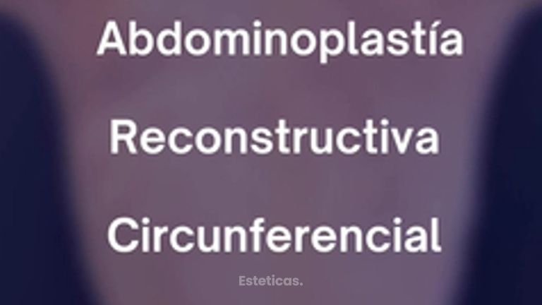 Abdominoplastia - Dr. Agustín Matia