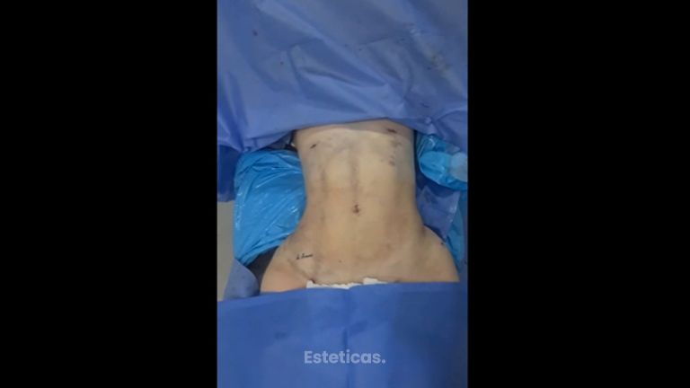 Liposucción - Dra. Paola León
