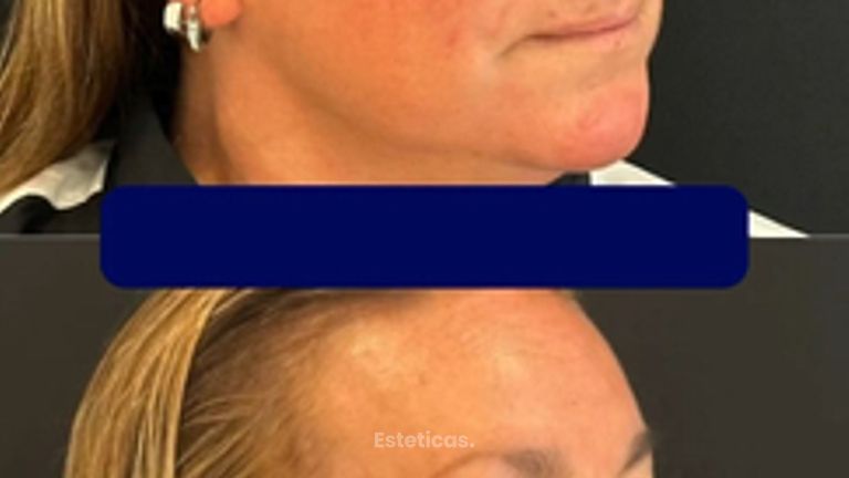 Rinoplastia - Dr. Agustín Matia