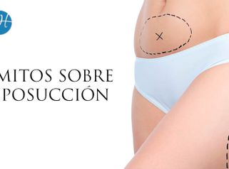 5 Mitos de la Liposucción - Dr. Honorio Labaronnie