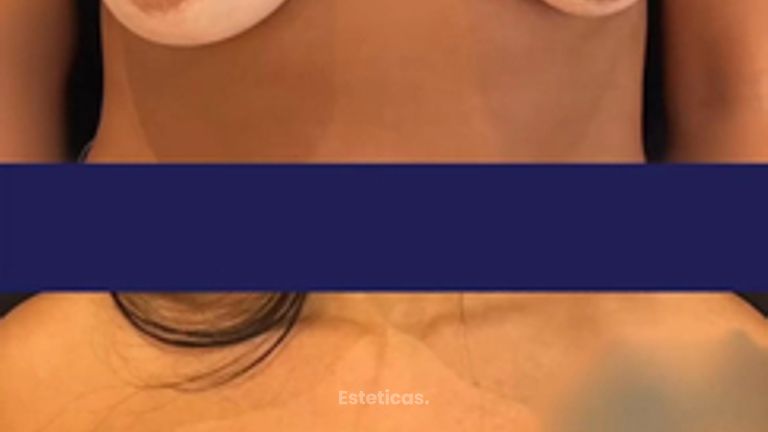 Aumento mamas - Dr. Agustín Matia