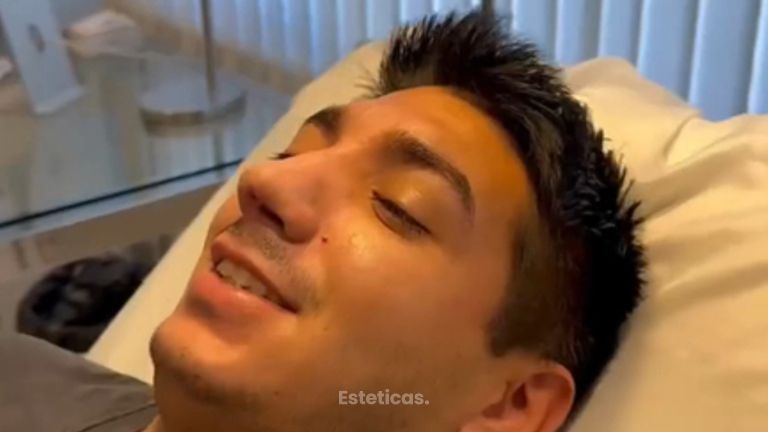 Rinoplastia - Dr. Agustín Matia