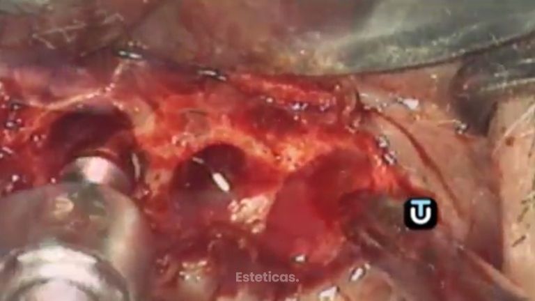 Los implantes mejoran tu sonrisa