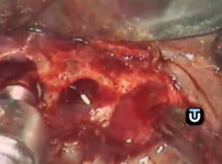 Los implantes mejoran tu sonrisa