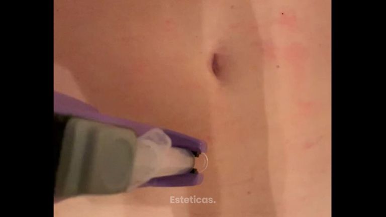 Tratamiento Mesoterapia
