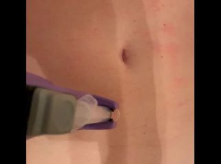 Tratamiento Mesoterapia
