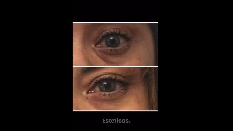 Foxy eyes - Dra. Georgina Vidal Bianchi